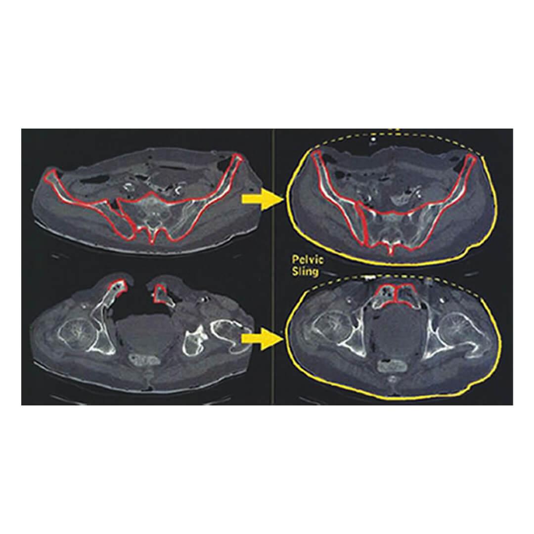 SAM Sling Otomatik Pelvik Sabitleme Kemeri - AcilTaktik